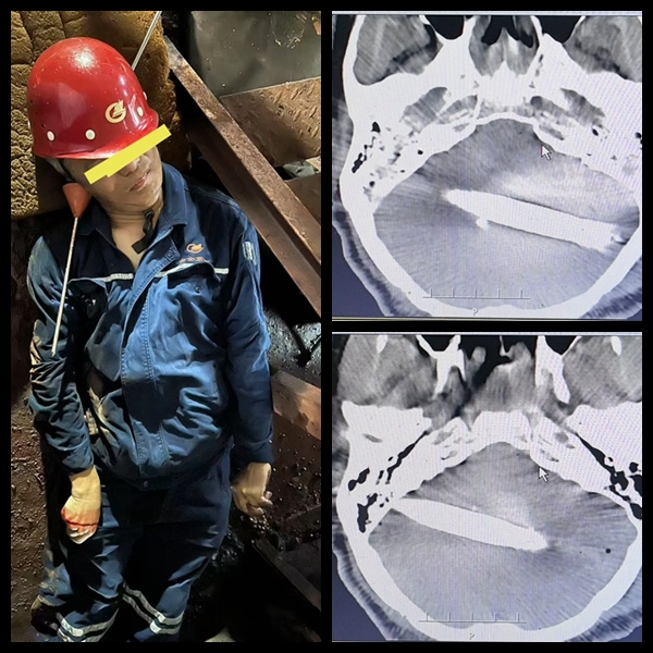 工人被拇指粗鋼筋貫穿顱腦 醫生雙側開顱從死神手里搶人