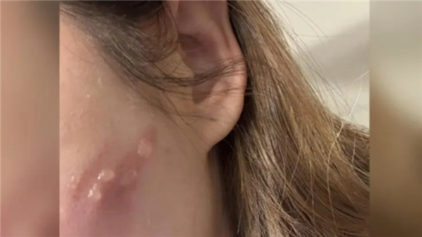 女生玩手機(jī)睡著：iPhone貼在臉上直接燙出4顆大水泡！